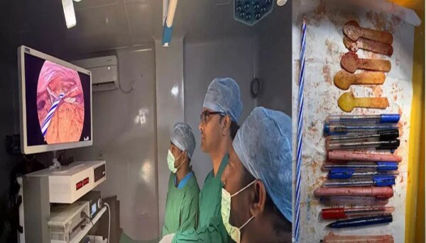India: 14 pens, 5 wooden spoons, candle found in woman’s stomach